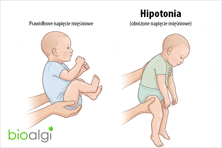 Hipotonia