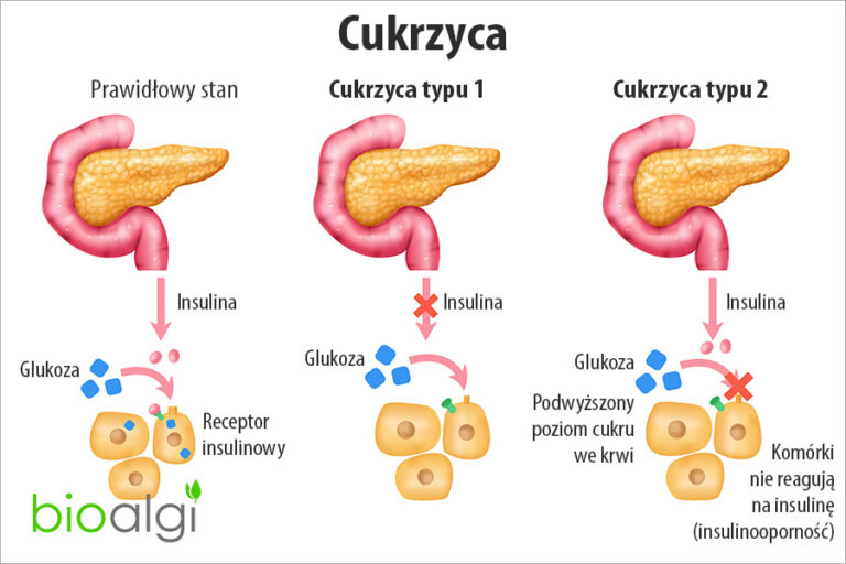 Cukrzyca