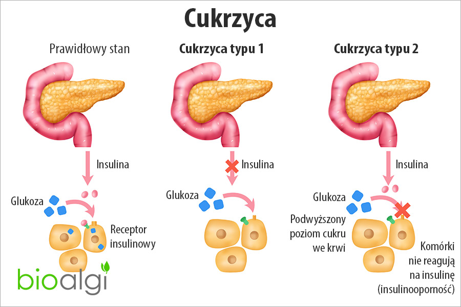 Cukrzyca