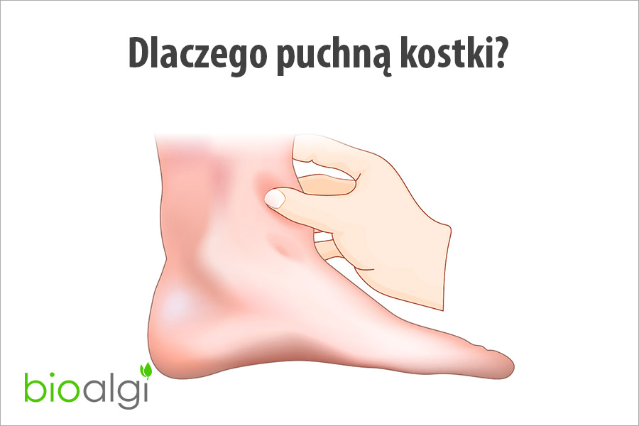 Dlaczego puchną kostki?