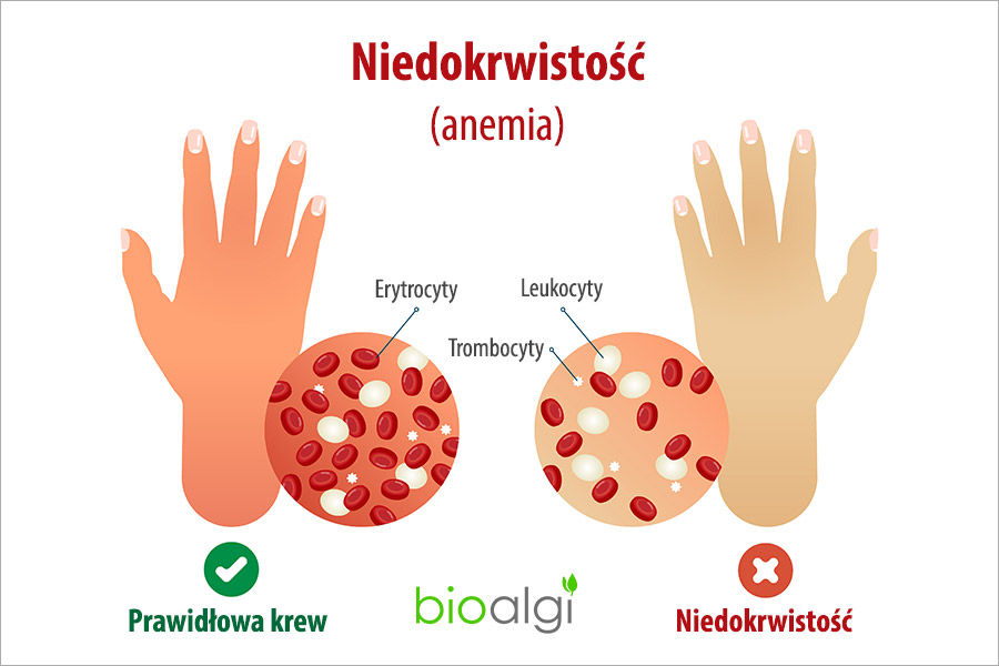 Niedokrwistość