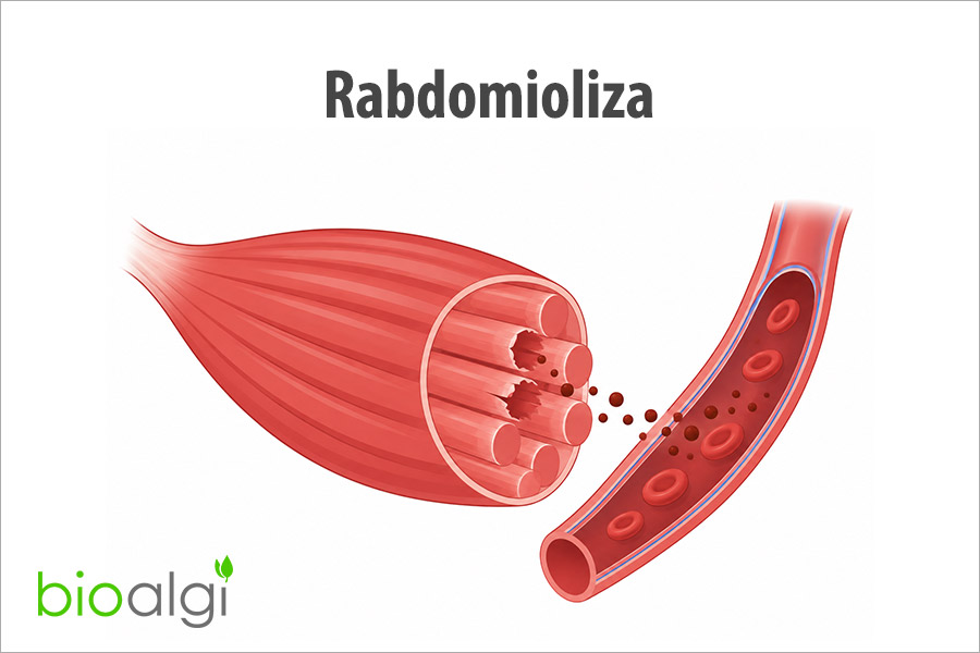 Rabdomioliza